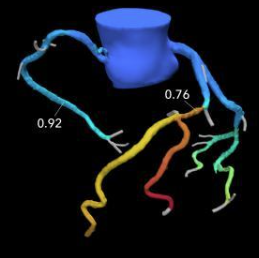 How HeartFlow's AI Tools Transform Cardiac Imaging